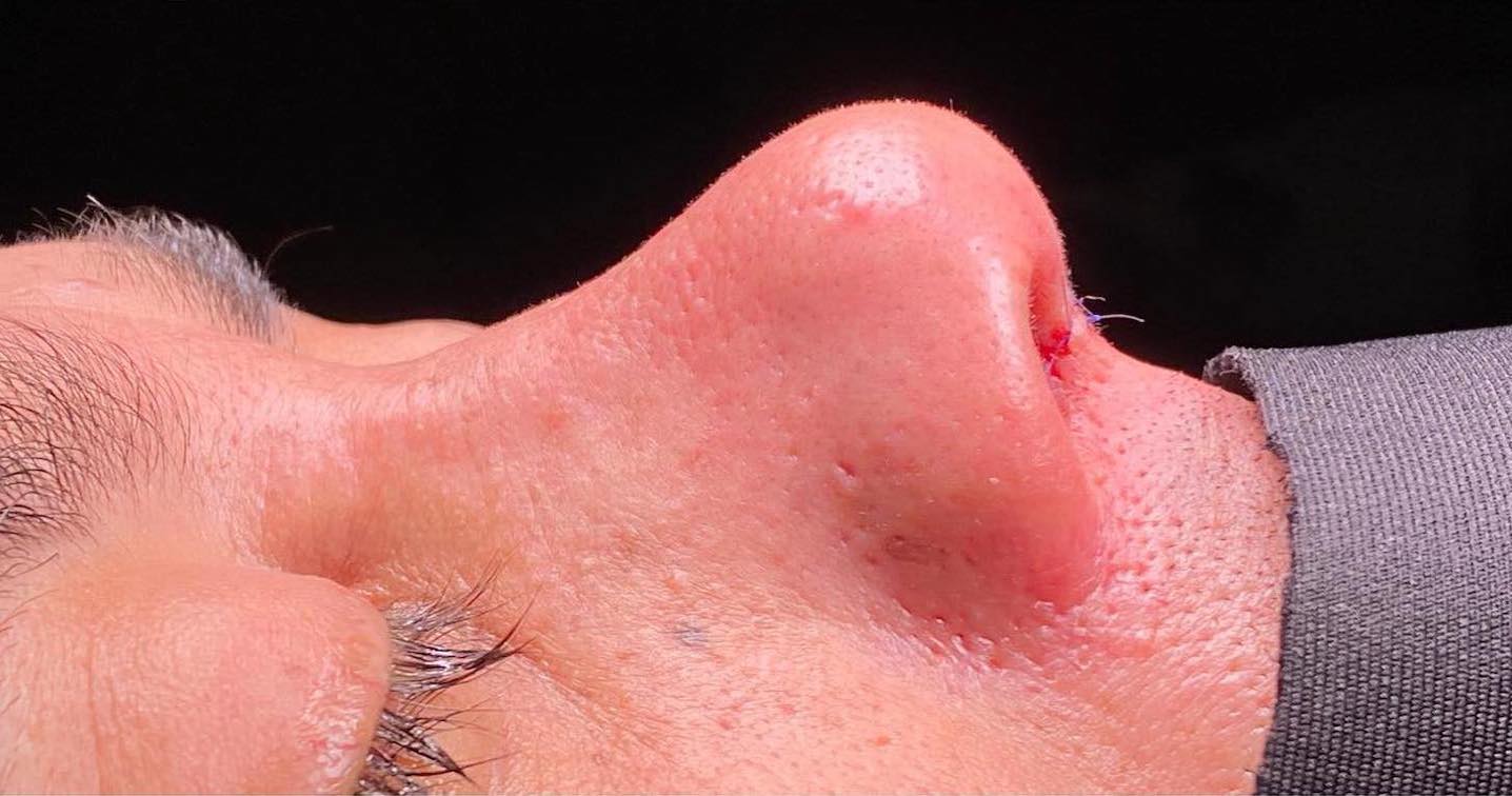 After-facefour