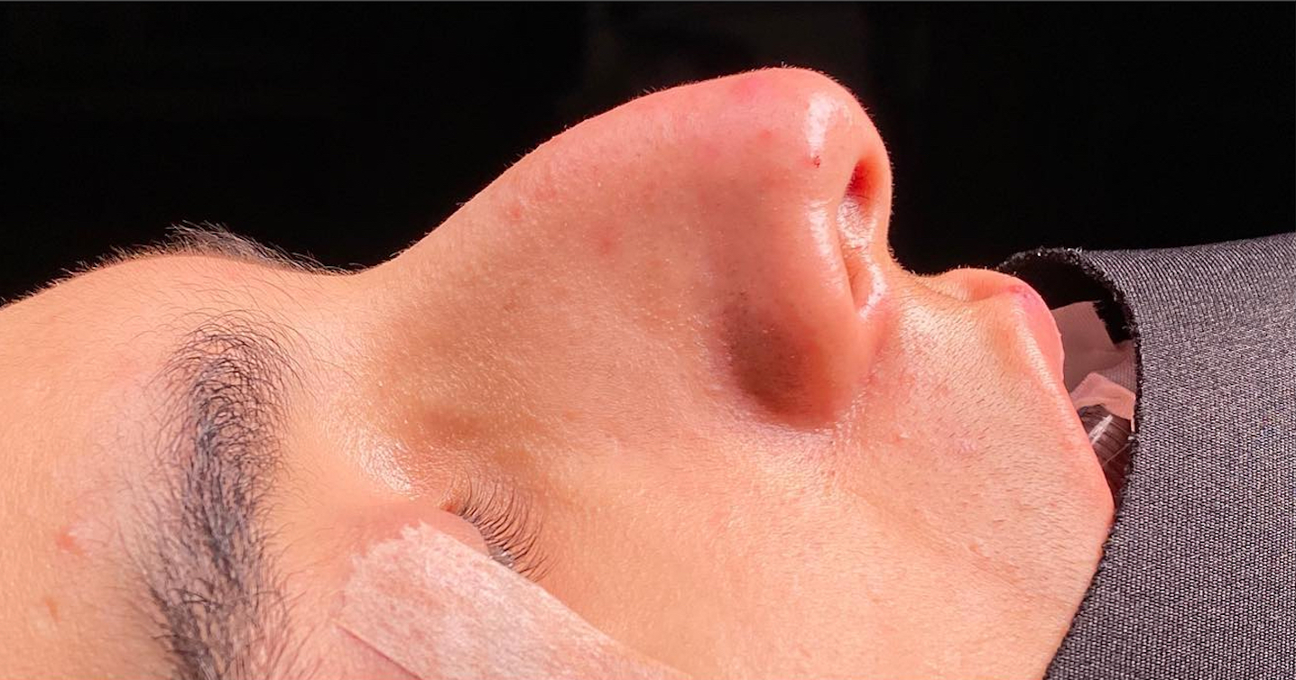 Before-facethree
